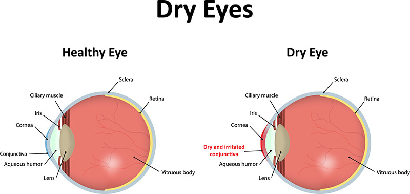 dry-eye-chart