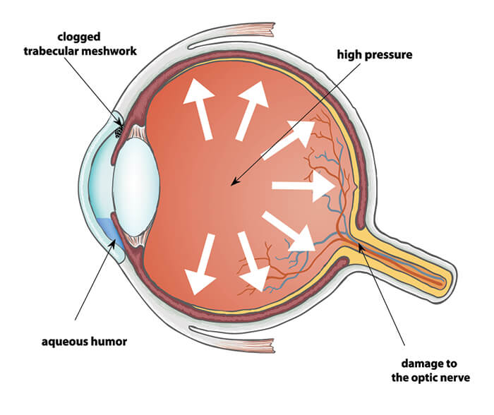 glaucoma-chart