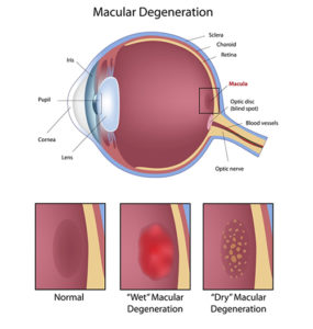 maculardegeneration-chart